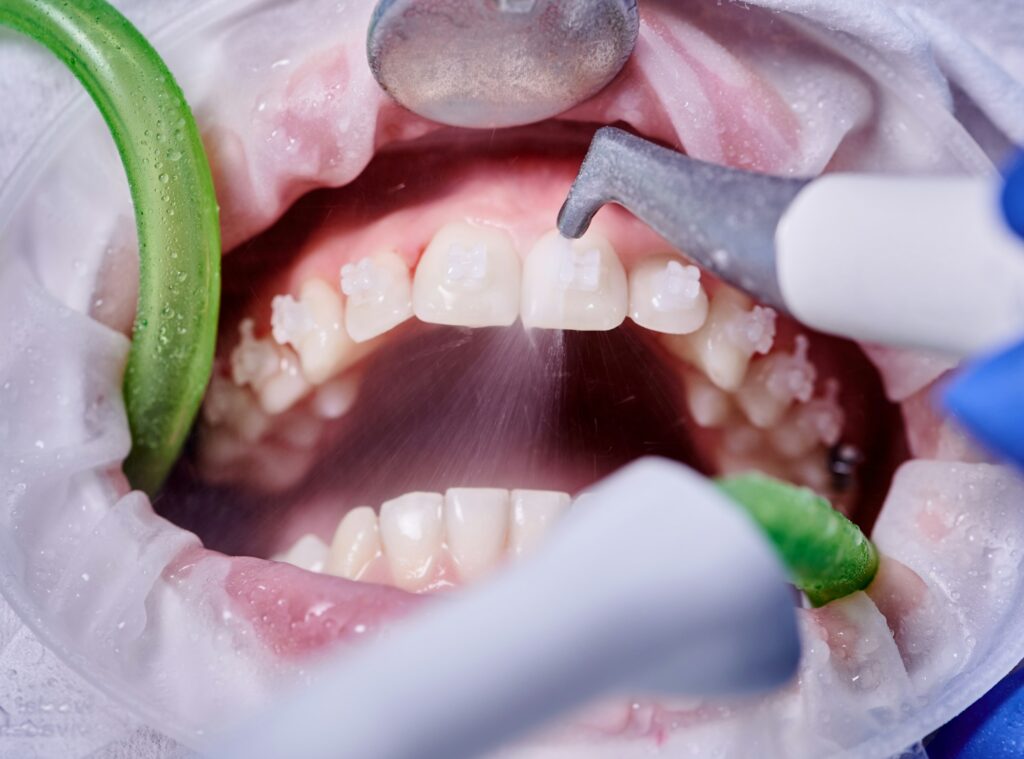 Doctor doing professional teeth cleaning in dental clinic