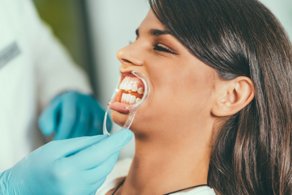 Tooth whitening procedure